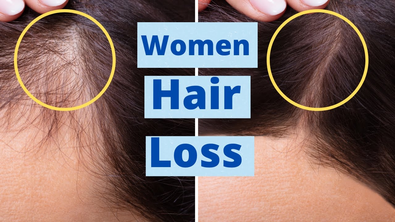 Stop Hair Loss For Women YouTube