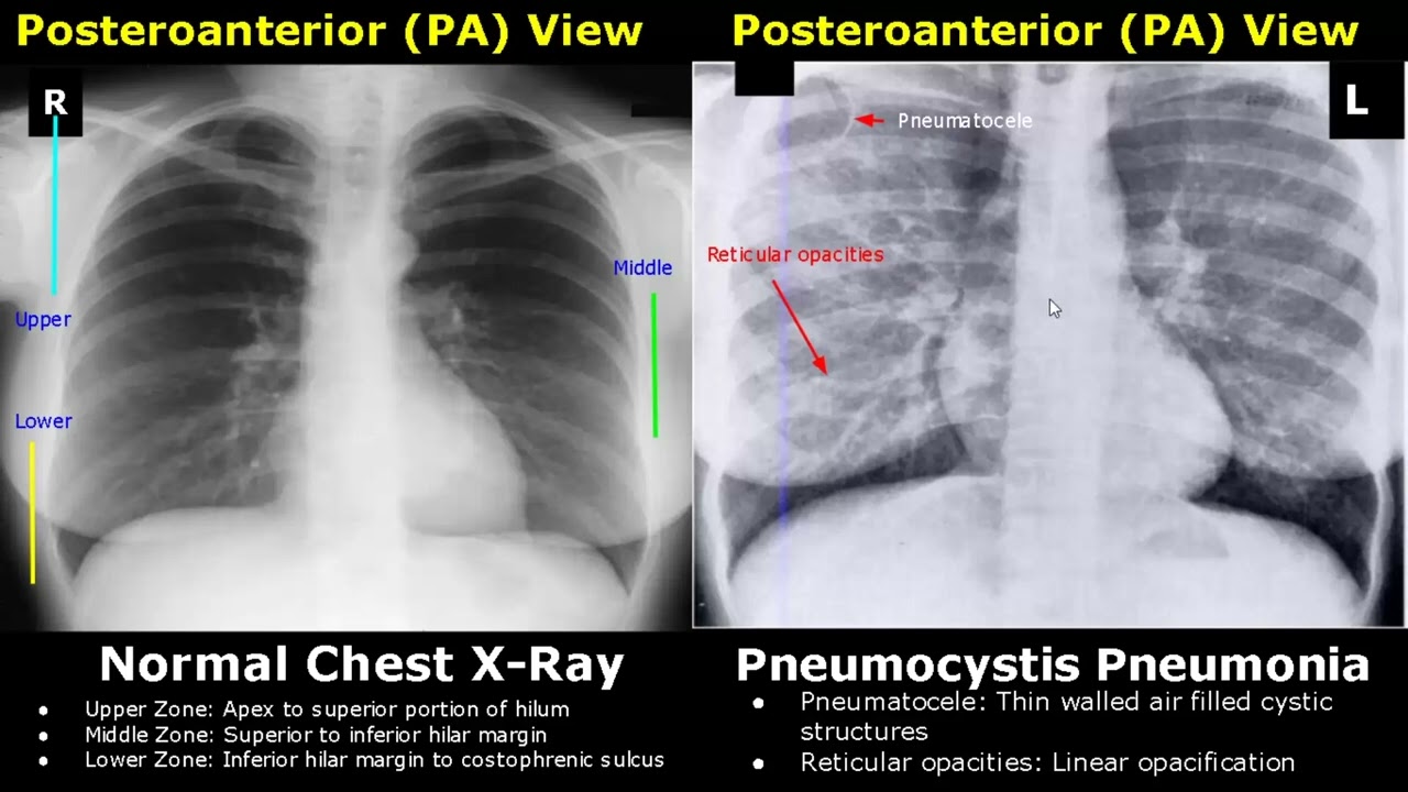 Chest X-Ray Lung Normal Vs Abnormal Image Appearances Part 1