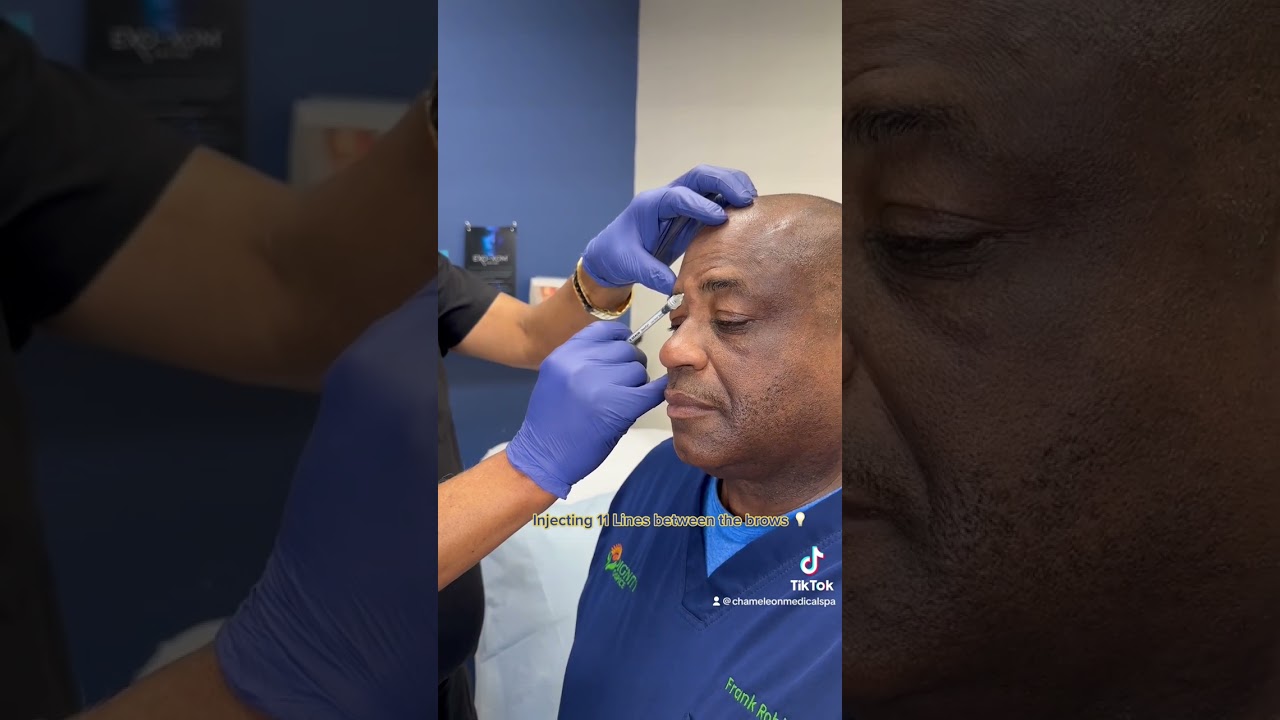 Botox Before and After