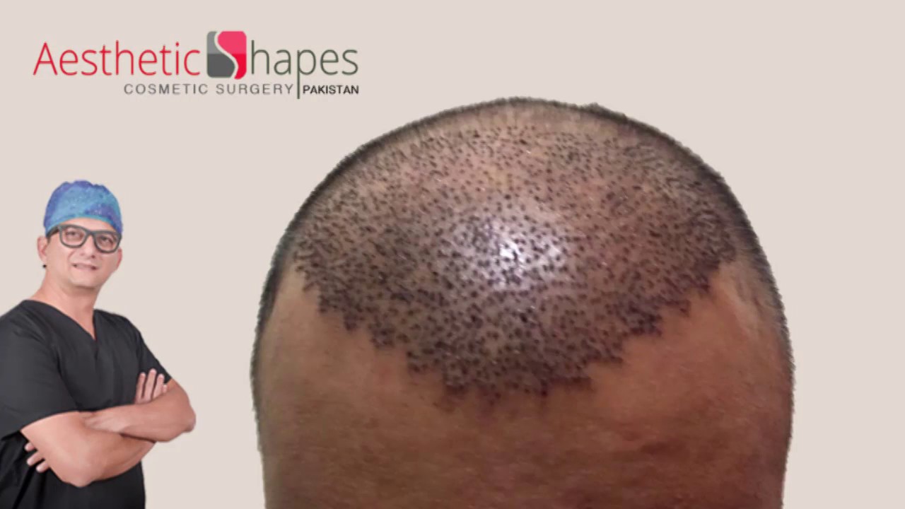 Hair Transplant in Karachi, Pakistan by Dr Arif Hussain YouTube