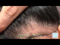 Dallas Asian Hair Transplant Correction