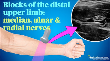 Ultrasound guided blocks of the median, ulnar and radial nerves