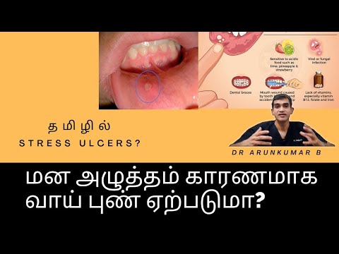 மன அழுத்தம் வாய் புண்களை ஏற்படுத்துமா? Dr Arunkumar Pearls Dentistry | Dental Clinic Chennai |