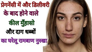 कील मुँहासो और दाग धब्बों के घरेलू रामबाण नुस्खे! Home remedy to cure acne pimples