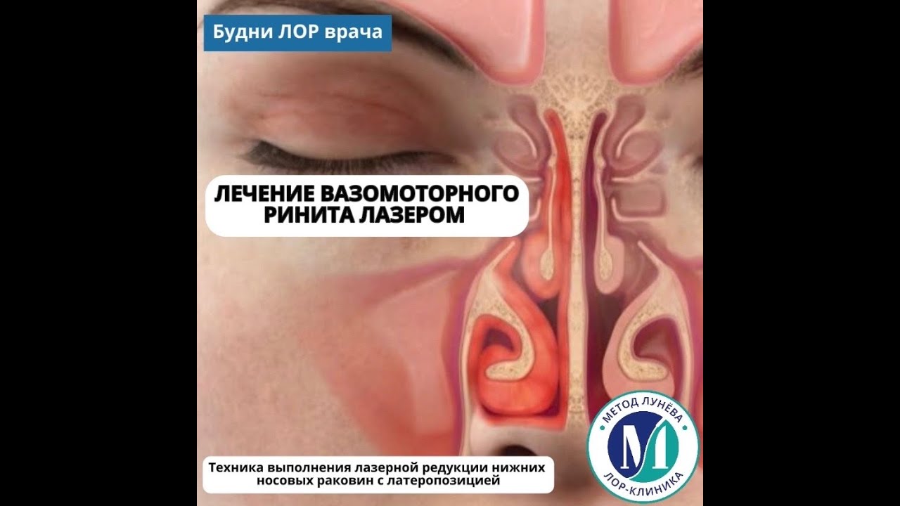 Вазомоторный ринит - лечение лазером.