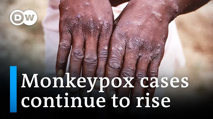 Monkeypox: Health officials assess response as cases spread | DW News - DayDayNews