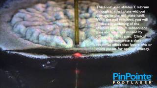 The Pinpointe Footlaser Ablates Trichophyton Rubrum