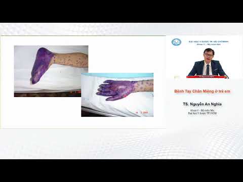 Video BÀI GIẢNG NHI KHOA: Bệnh Tay Chân Miệng - TS Nguyễn An... - YouTube