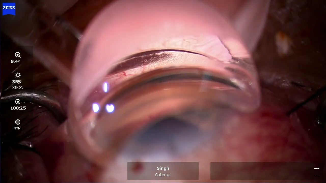 OMNI Canal Dilation and Ototmy Using Stay Sutures - Paul Singh