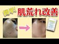 【即効性】肌荒れを改善するサプリの飲み方を1つ紹介！この方法で劇的に変化しました。【ニキビ・乾燥肌】