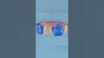 ❤️Midline Diastema Closure | Direct Composite | Your Dentist | #shots #shortvideo #directrestoration