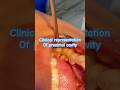 Clinical representation of #dentalcavity 🦷 #dentalstudents #indiandentist @5MinuteCraftsYouTube