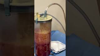 Post Op Week 1: Abdominal Etching