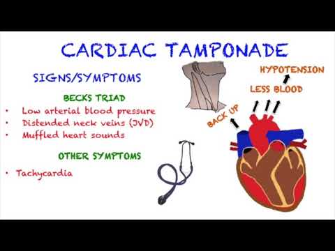 cardiac tamponade symptoms