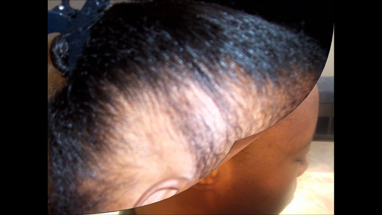 alopecia hair growth