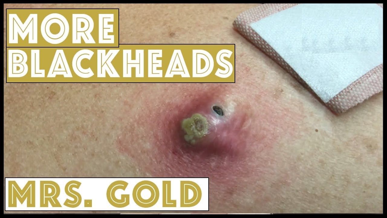 Big Pimples And Inflamed Acne Extraction On Face 