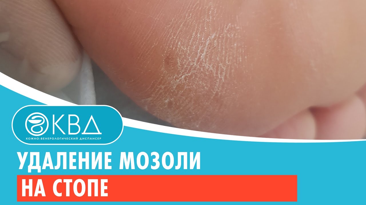 Удаление мозоли на стопе. Клинический случай №929 - YouTube