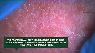 Most Satisfying Hair Removal from Men's Beard | Ingrown Hair | CLOSEUP | Jade Clinics