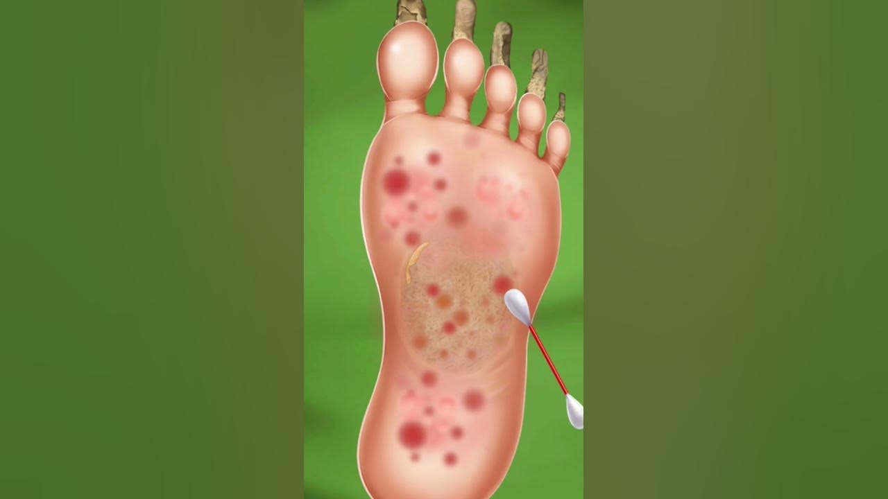 Asmr remove parasites from foot foot treatment shots newsots youtube