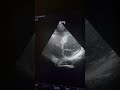 Chiari Network - Transthoracic Echocardiography (AP4C, SAX view)