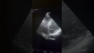 Chiari Network - Transthoracic Echocardiography (AP4C, SAX view)