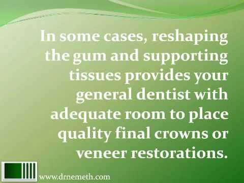 Cosmetic Crown Lengthening to Correct a Gummy Smile