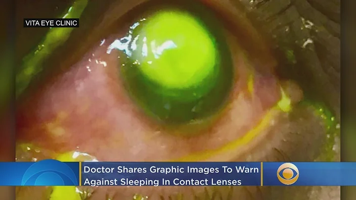 Doctors Shares Graphic Images To Warn Against Sleeping In Contact Lenses - DayDayNews