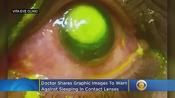 Doctors Shares Graphic Images To Warn Against Sleeping In Contact Lenses
