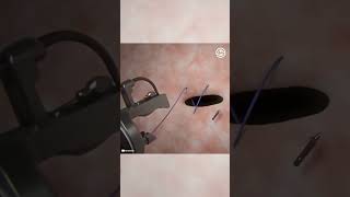 Tiny Endoscopic Suturing System for Bariatric Surgery (Weight Loss Surgery)