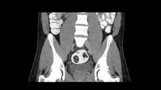 Radiology Rounds @ radRounds.com: A Radiologist Auntminnie - CT of abdomen/pelvis of appendicitis. screenshot 4