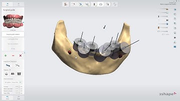 Performing the workflow for bone supported guide in Implant Studio