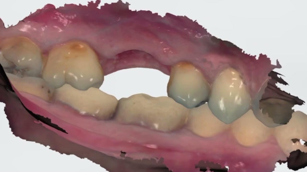 Medit i900 vs Trios 5 scanning