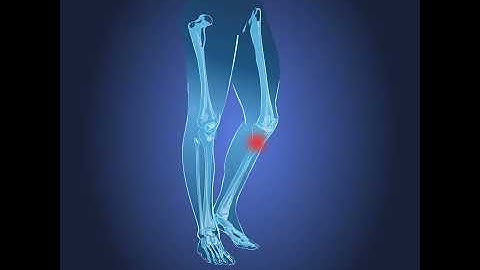 Proximal Tibia Fracture | Orthopedic Trauma Portfolio | GPC Medical Ltd.
