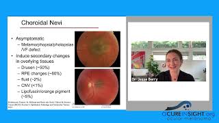 Navigating a Uveal Melanoma Diagnosis