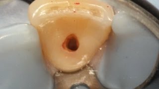 Internal resorption treatment with narration