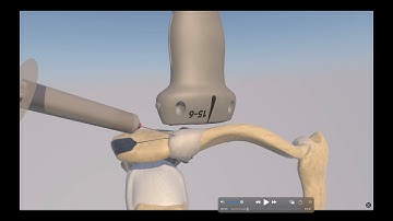 Ultrasound Guided Acromioclavicular Joint Injection by probeultrasound.com