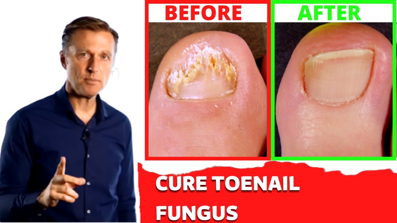 Treating toenail fungus Home Remedy Natural Dr Berg YouTube