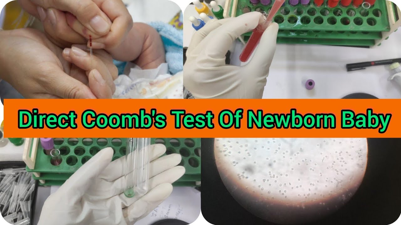 Direct Coomb s Test Procedure Rh ve Newborn Baby Erythroblastosis direct-coomb-s-test-procedure-rh-ve-newborn-baby-erythroblastosis
