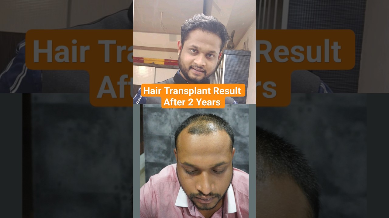 Hair Transplant Result After 2 Years #hairtransplant #shortsvideo - YouTube