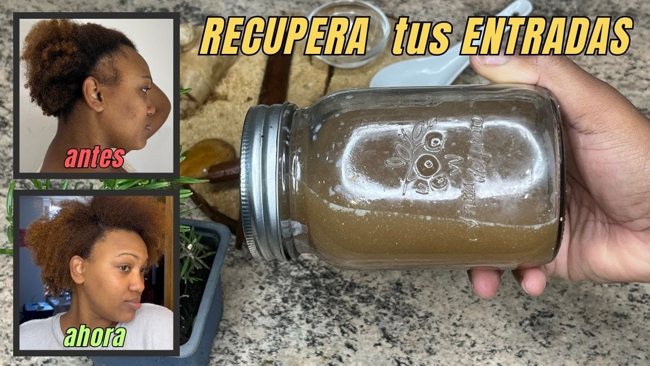 REMEDIO PARA HACER CRECER EL CABELLO DE LAS ENTRADAS *Cómo Recuperar las Entradas  mujeres y hombres