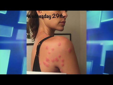Video: Bed Bug Bites Vs. Mosquito Bites: Fortælle Dem Fra Hinanden