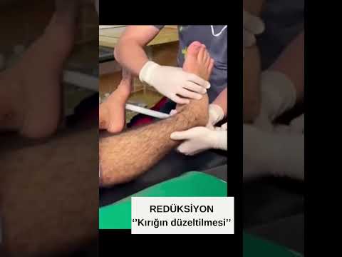 Redüksiyon, Kırığın düzeltilmesi, Tabi ki anestezi altında, Prof.Dr.Serdar Akgün