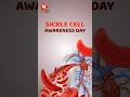 Sickle cell awareness day ( tal radio) - सिकल सेल जागरूकता दिवस (टीएएल रेडियो)