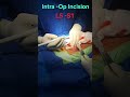 how to remove Bullet In L5-S1 Vertibra #hospital #bestmedicalcollegeinindia #nurse #doctor #ottech