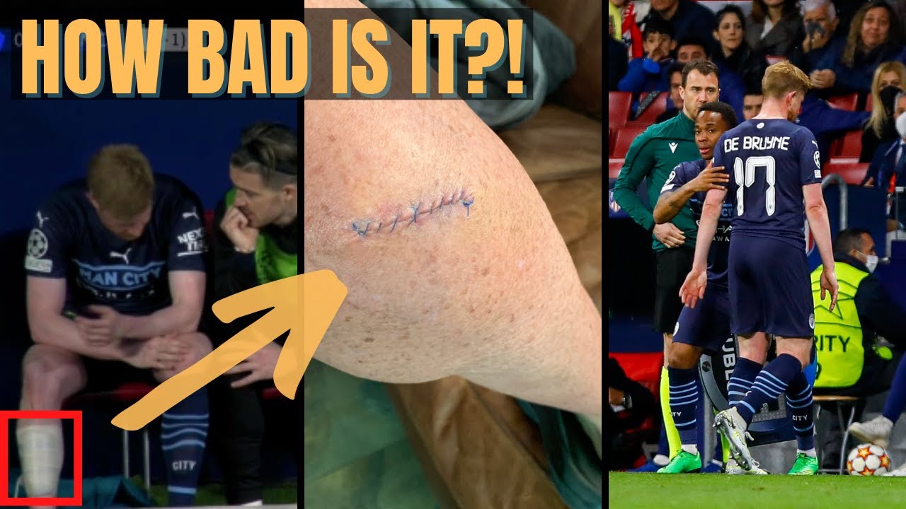 Expert Explains Kevin De Bruyne Injury Calf Hazy Return Timeline expert-explains-kevin-de-bruyne-injury-calf-hazy-return-timeline
