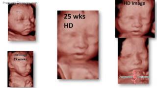25 Week 3D - High Definition Ultrasound