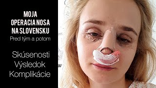 OPERÁCIA NOSA - moja skúsenosť