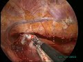 Bilobectomy+mediastinal lymphnode biopsy