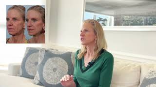 Facelift Journey | "Over 8 Consults from NYC to Boston, Dr. Williams was the One for Me"