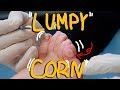 Satisfying Corn Removal with Callus: HUGE LUMPY Corn!!